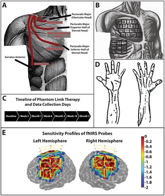 Phantom limb therapy improves cortical efficiency of the sensorimotor network in a targeted muscle reinnervation amputee: a case report